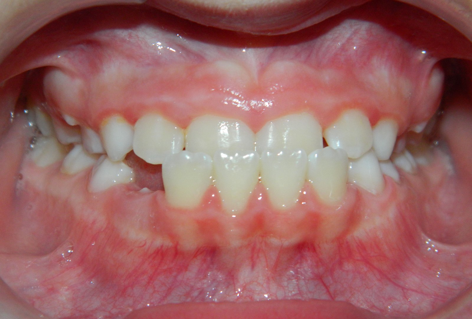 Antes